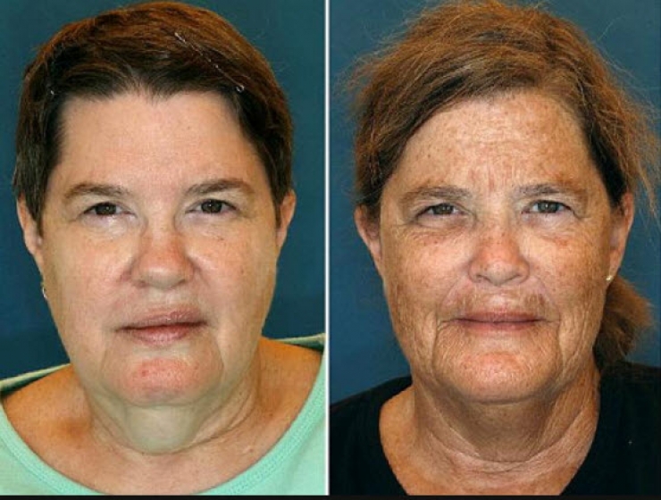 Illustration de l'article : Smokers vs. Non-smokers... These 8 pictures of twins show us that the difference is obvious!