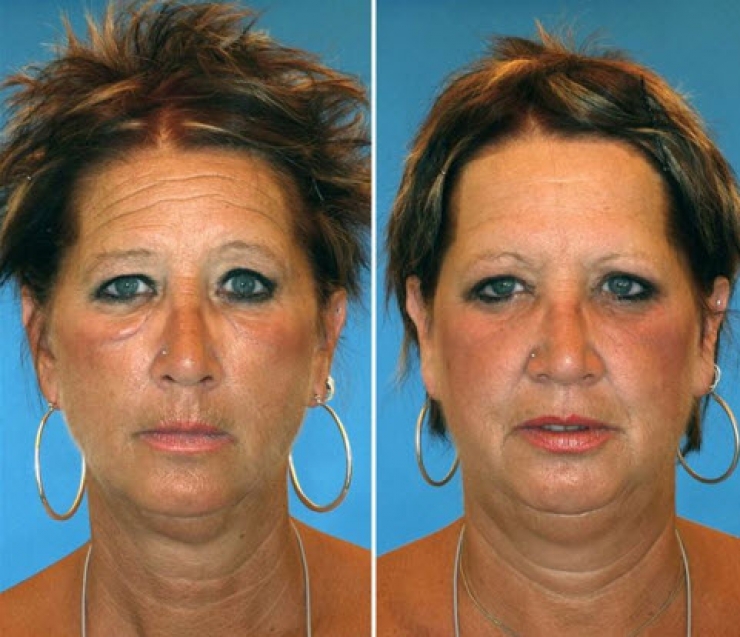 Illustration de l'article : Smokers vs. Non-smokers... These 8 pictures of twins show us that the difference is obvious!
