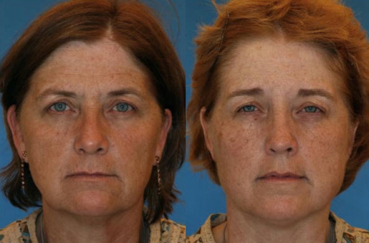 Illustration de l'article : Smokers vs. Non-smokers... These 8 pictures of twins show us that the difference is obvious!