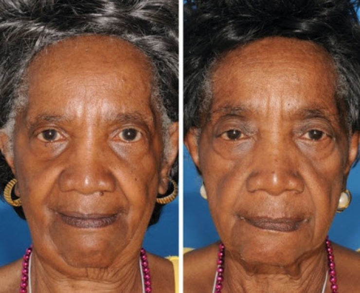 Illustration de l'article : Smokers vs. Non-smokers... These 8 pictures of twins show us that the difference is obvious!