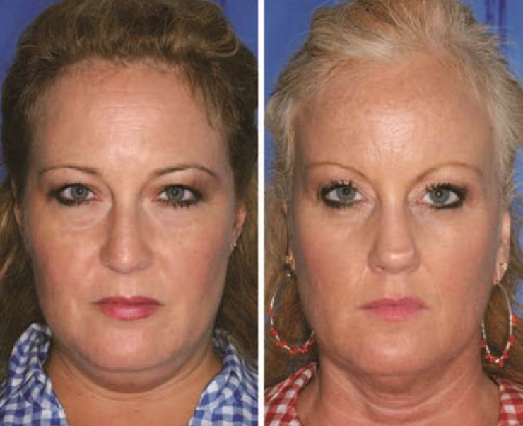 Illustration de l'article : Smokers vs. Non-smokers... These 8 pictures of twins show us that the difference is obvious!