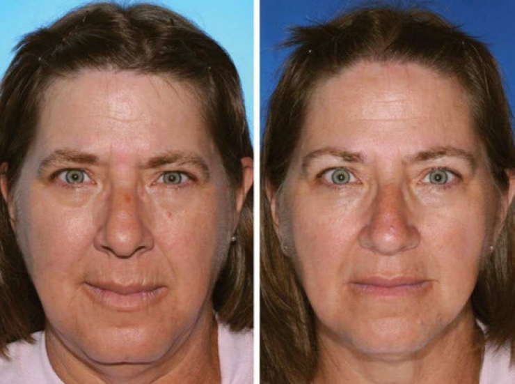 Illustration de l'article : Smokers vs. Non-smokers... These 8 pictures of twins show us that the difference is obvious!