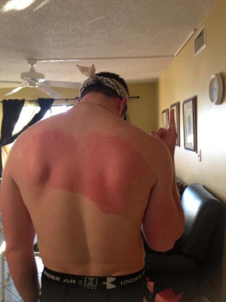 Illustration de l'article : The 24 most awkward tan lines this summer...