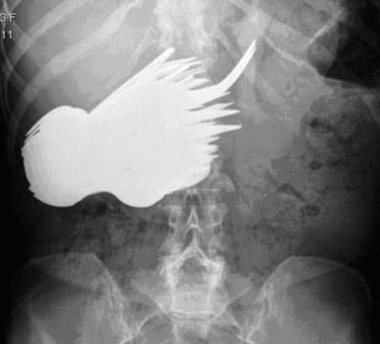 Illustration de l'article : Individuals who got unusual objects stuck in their bodies... 18 X-rays you won’t believe!