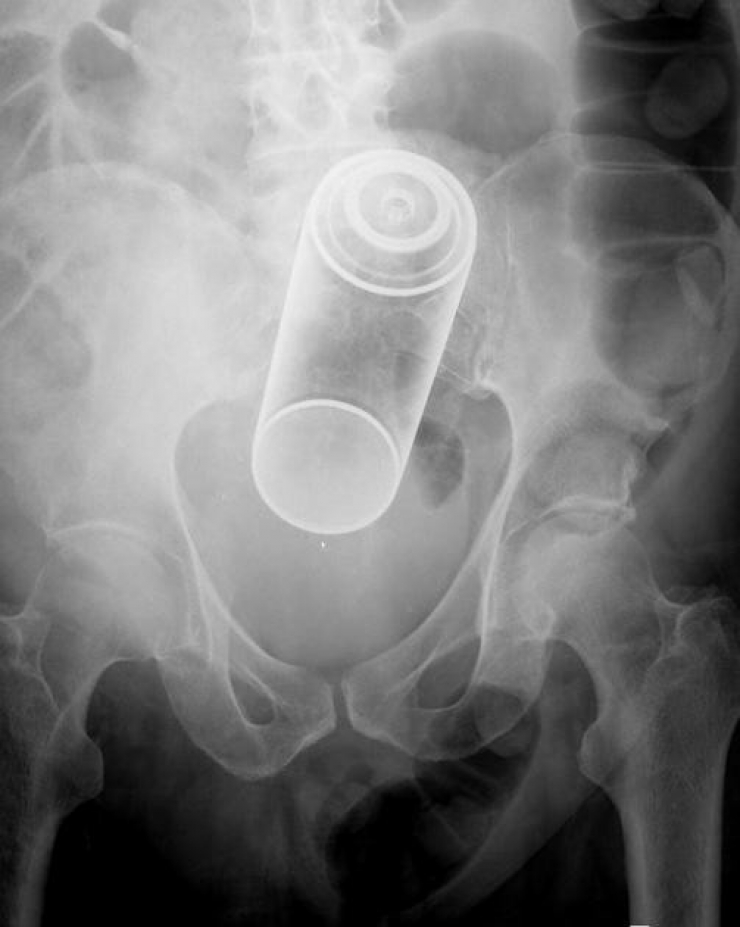 Illustration de l'article : Individuals who got unusual objects stuck in their bodies... 18 X-rays you won’t believe!