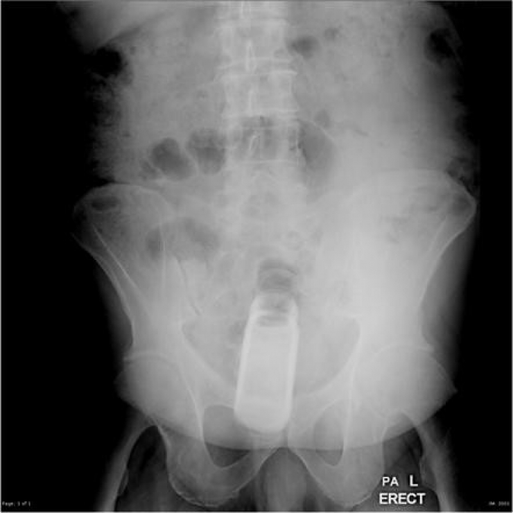 Illustration de l'article : Individuals who got unusual objects stuck in their bodies... 18 X-rays you won’t believe!