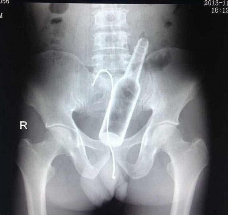 Illustration de l'article : Individuals who got unusual objects stuck in their bodies... 18 X-rays you won’t believe!