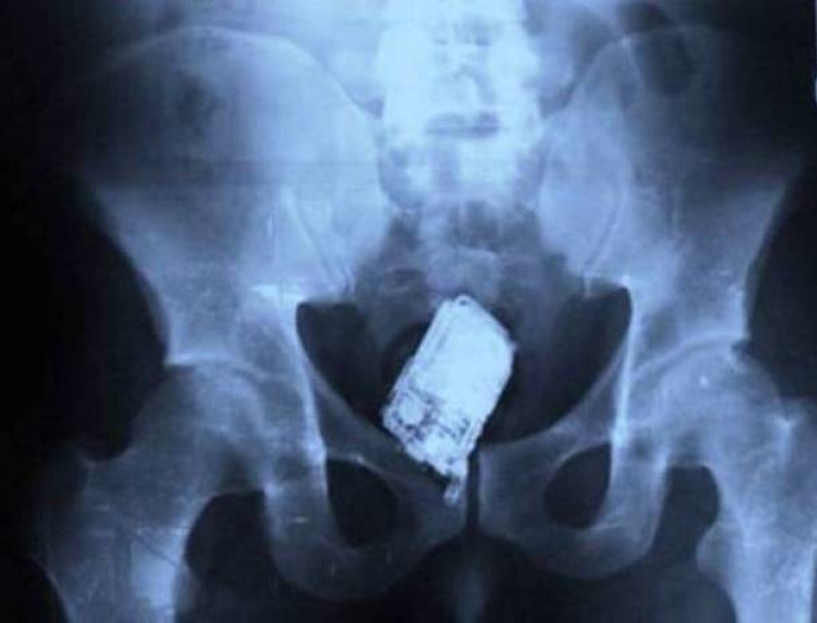 Illustration de l'article : Individuals who got unusual objects stuck in their bodies... 18 X-rays you won’t believe!