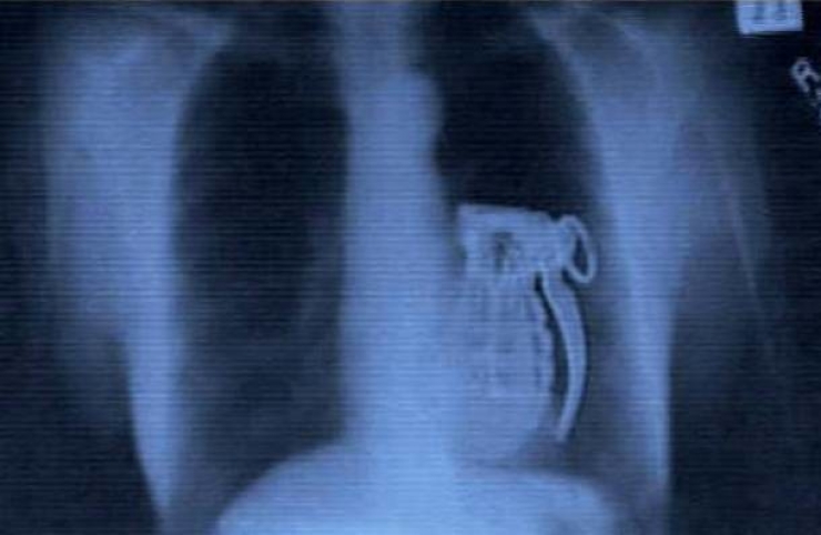 Illustration de l'article : Individuals who got unusual objects stuck in their bodies... 18 X-rays you won’t believe!