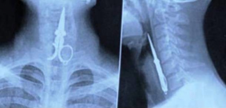 Illustration de l'article : Individuals who got unusual objects stuck in their bodies... 18 X-rays you won’t believe!