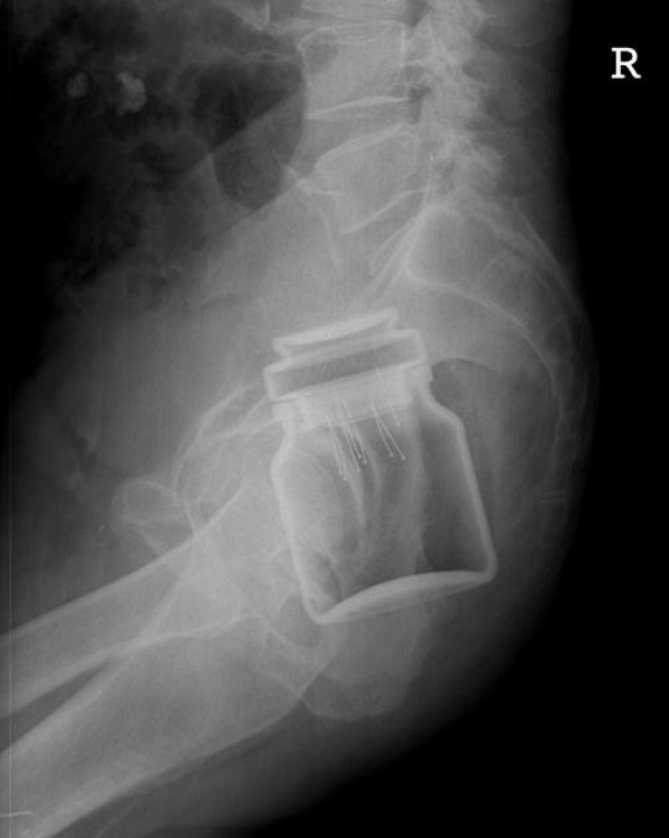 Illustration de l'article : Individuals who got unusual objects stuck in their bodies... 18 X-rays you won’t believe!