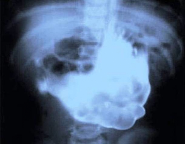 Illustration de l'article : Individuals who got unusual objects stuck in their bodies... 18 X-rays you won’t believe!