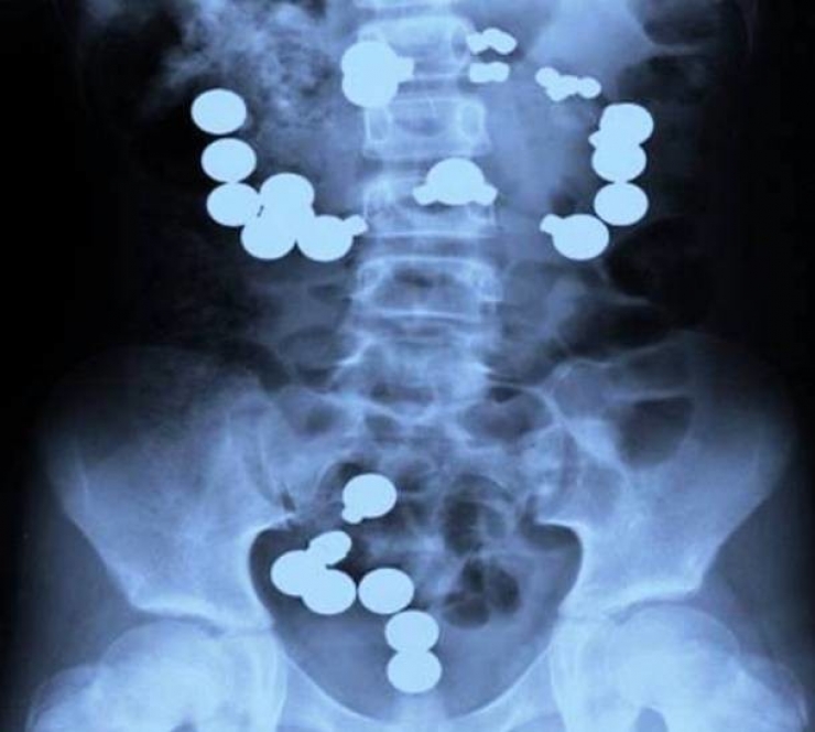 Illustration de l'article : Individuals who got unusual objects stuck in their bodies... 18 X-rays you won’t believe!