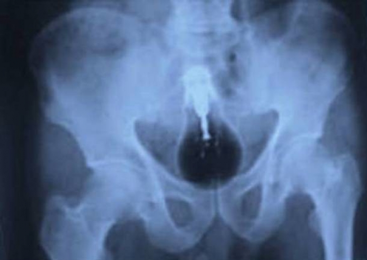 Illustration de l'article : Individuals who got unusual objects stuck in their bodies... 18 X-rays you won’t believe!