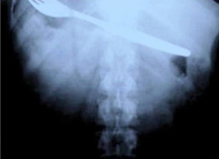 Illustration de l'article : Individuals who got unusual objects stuck in their bodies... 18 X-rays you won’t believe!