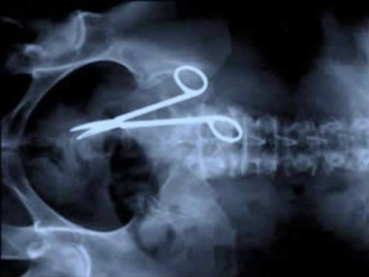 Illustration de l'article : Individuals who got unusual objects stuck in their bodies... 18 X-rays you won’t believe!