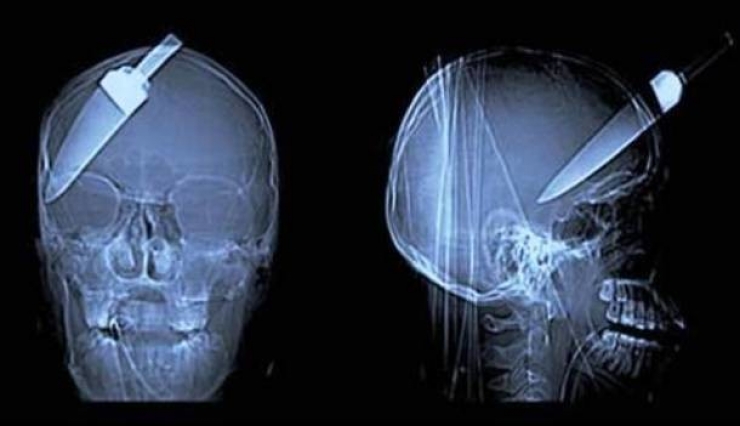 Illustration de l'article : Individuals who got unusual objects stuck in their bodies... 18 X-rays you won’t believe!