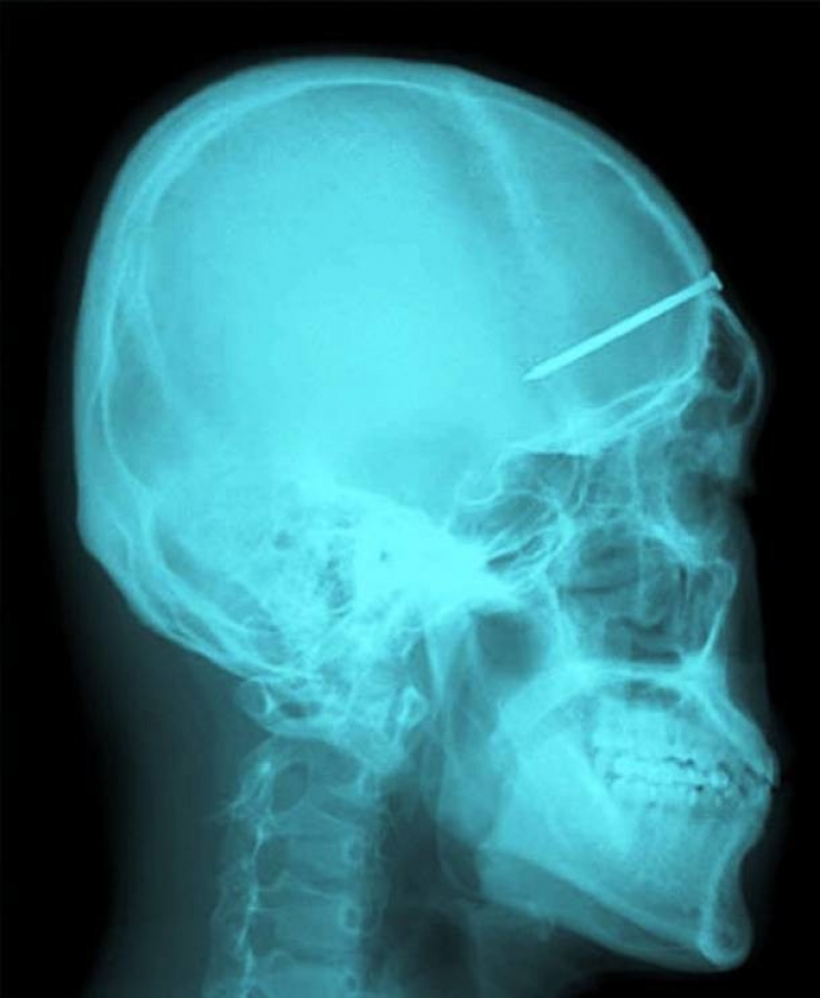 Illustration de l'article : Individuals who got unusual objects stuck in their bodies... 18 X-rays you won’t believe!