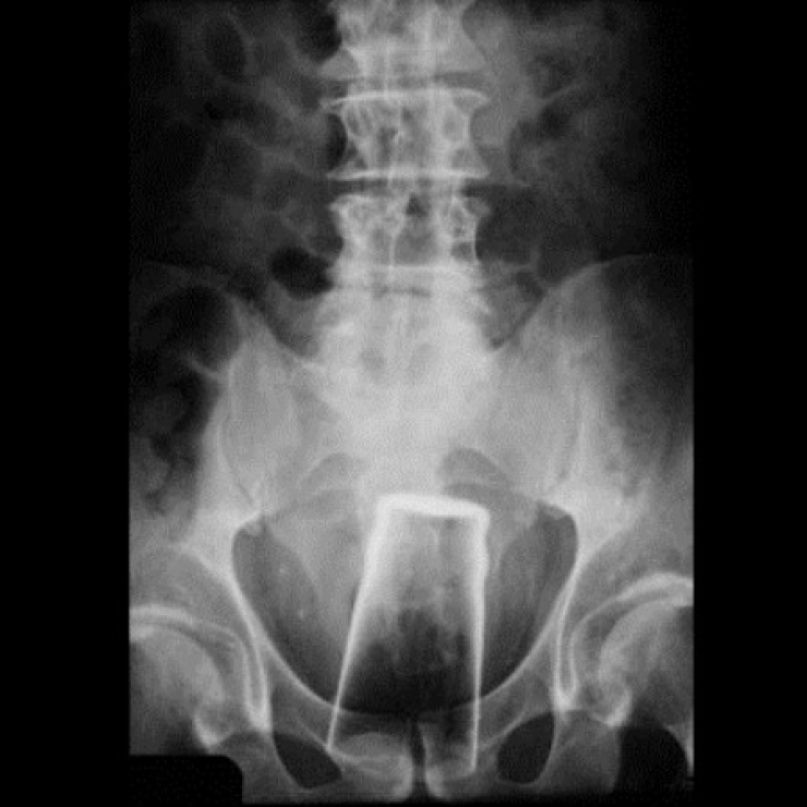 Illustration de l'article : Individuals who got unusual objects stuck in their bodies... 18 X-rays you won’t believe!