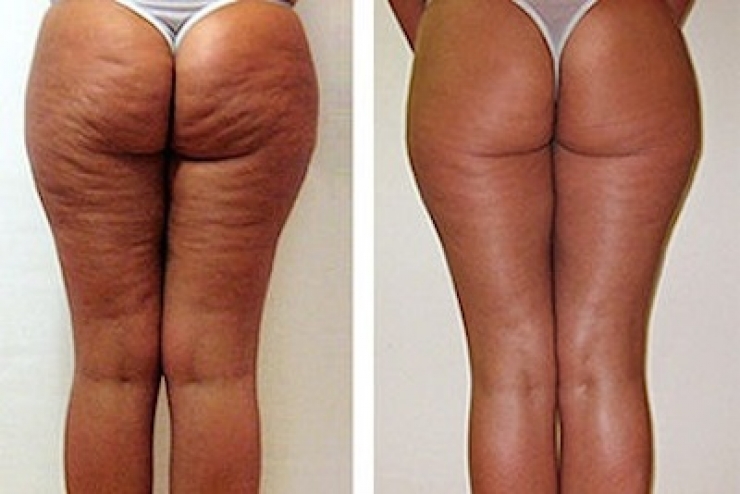 Illustration de l'article : What she smears on her bottom, we all have at home &ndash; but no one uses it!