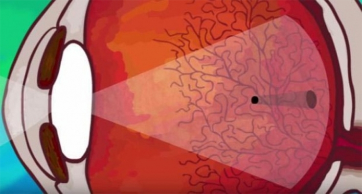 Illustration de l'article : Here's why you sometimes see floaters obstructing your vision... This is reassuring!