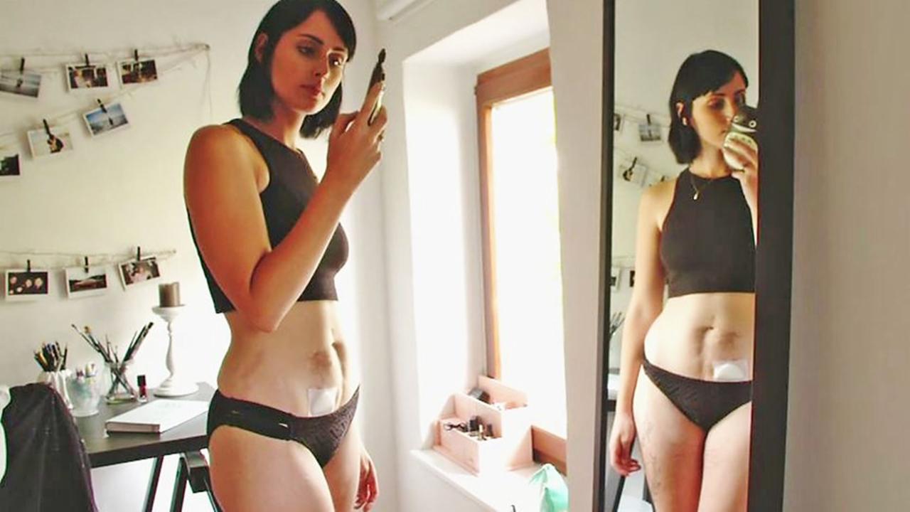 Illustration de l'article : They removed her intestine when she was 16, and today the photos of her body and her project touch everyone!