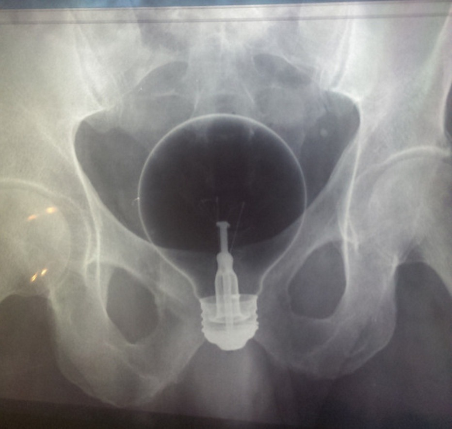 Illustration de l'article : Doctors reveal 17 bizarre objects that they had to remove from their patients’ genitals...