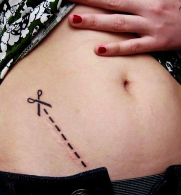 Illustration de l'article : 30 amazing tattoos that turn scars into works of art