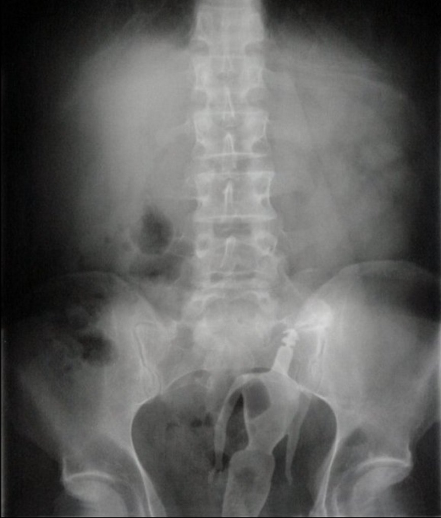 Illustration de l'article : Doctors reveal 17 bizarre objects that they had to remove from their patients’ genitals...