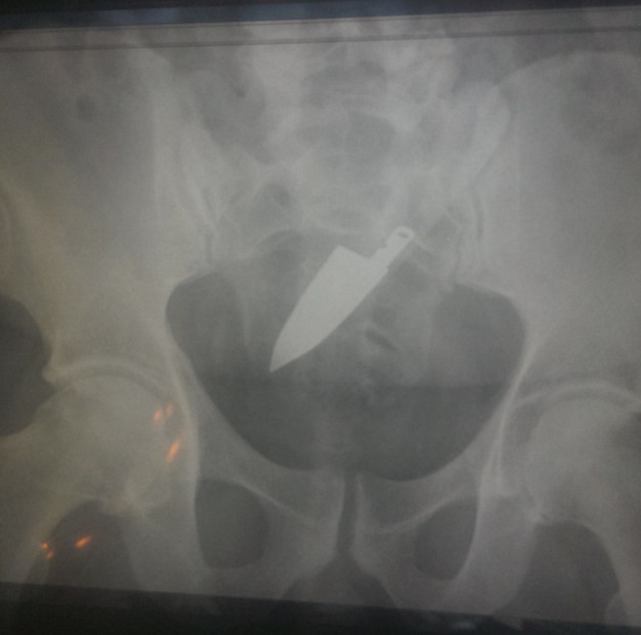 Illustration de l'article : Doctors reveal 17 bizarre objects that they had to remove from their patients’ genitals...